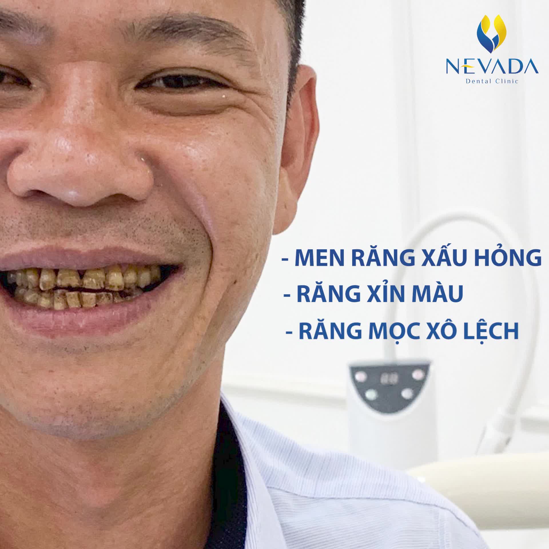 TÁI SINH NỤ CƯỜI VỚI 20 RĂNG SỨ ZIRCONIA CAO CẤP