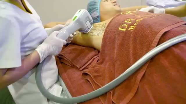 CÙNG XEM QUY TRÌNH ĐIỀU TRỊ CHỨNG TĂNG TIẾT MỒ HÔI NÁCH DOUBLE MIRADRY
