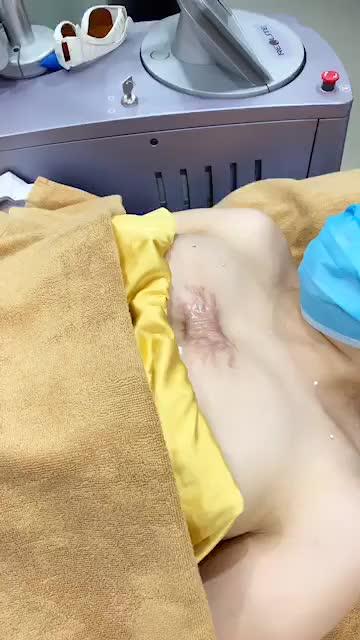 "NHỨC MẮT" VỚI SẸO LỒI SIÊU TO KHỔNG LỒ CỦA KH.