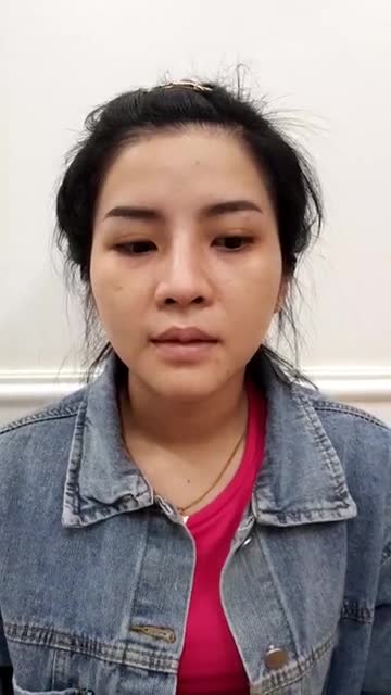 Cằm thanh tú - Miệng cười xinh nhờ ĐỘN CẰM  TẠO MÔI TIM