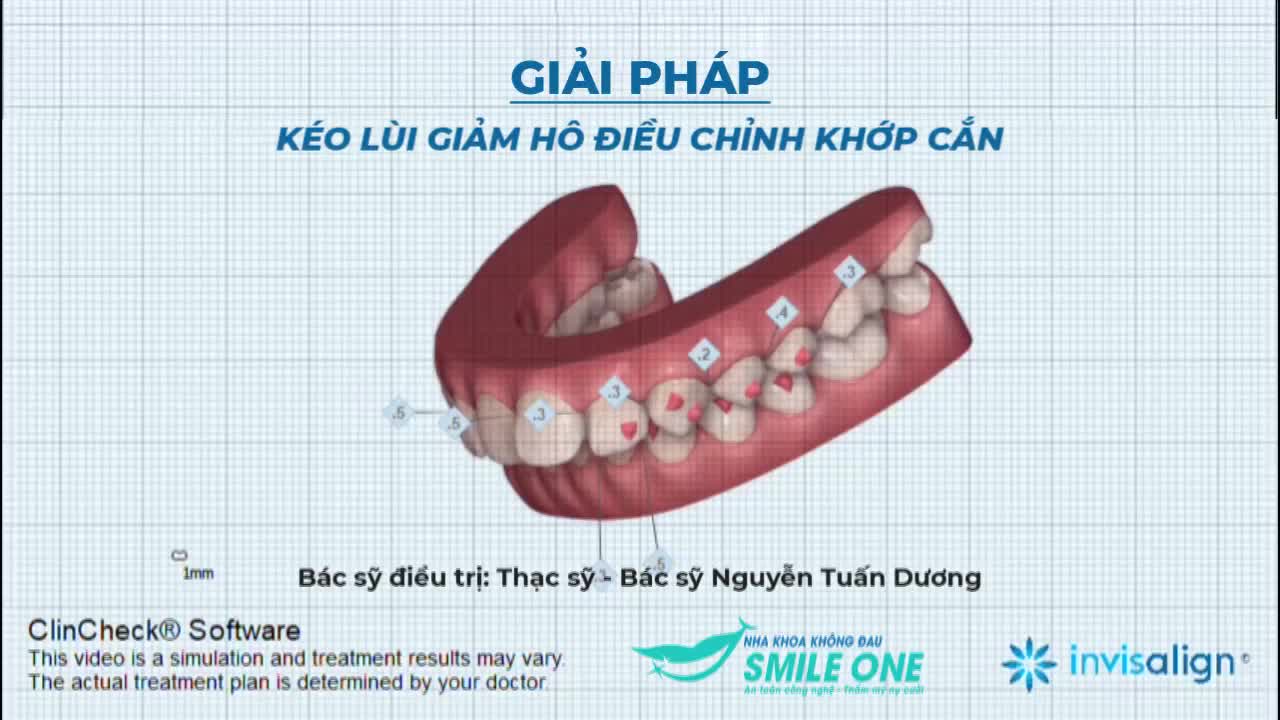 GIẢI PHÁP KÉO LÙI GIẢM HÔ, ĐIỀU CHỈNH KHỚP CẮN - NIỀNG RĂNG TRONG SUỐT INVISALIGN