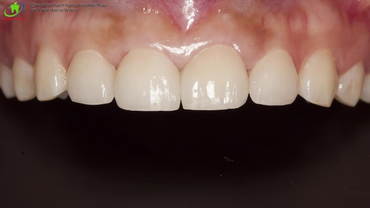 DÁN SỨ VENEER AN TOÀN NGAY TẠI NHA KHOA THÙY ANH