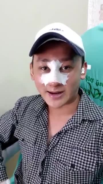 Ngày đầu tiên sau Nâng mũi phương pháp: Sụn sườn - Đục xương