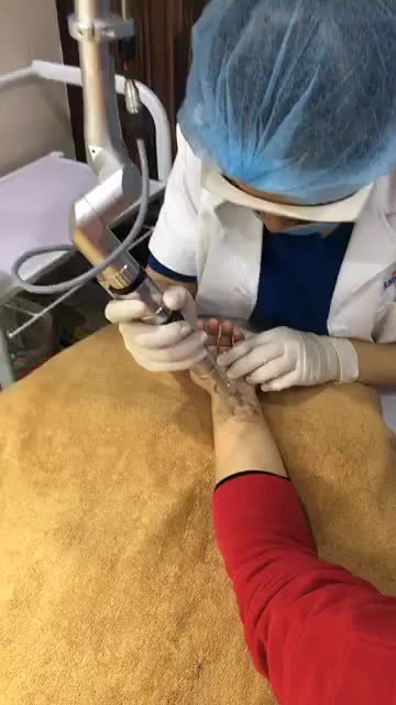 Cận cảnh xoá xăm laser sau 3 buổi.