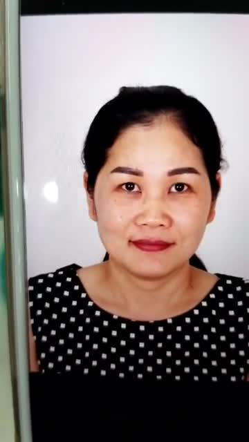 Phẫu thuật nâng mũi Siêu cấu trúc surgiform cân thái dương Mũi đẹp hoàn hảo luôn mọi người ơi