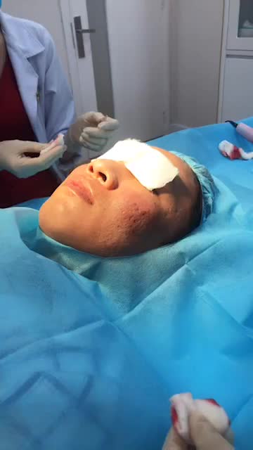 BiOcar phương pháp hồi phục da, điều trị sẹo an toàn, hiệu quả , đánh bay sẹo lõm chỉ trong vài lần điều trị . Da đẹp sáng mịn lên tức thì