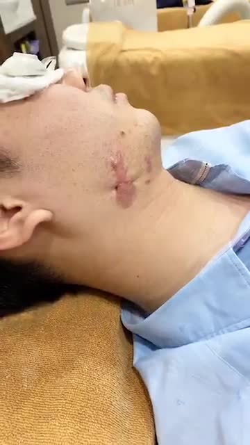 Hành trình giải cứu SẸO LỒI mất thẩm mỹ trên mặt, tay
