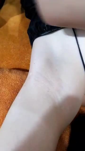 Triệt lông nách công nghệ Dioe Laser.