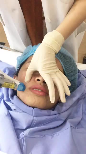 Sẹo lõm rỗ cải thiện rõ rệt hơn với công nghệ Bio Scar - độc quyền chỉ có tại Đông Á