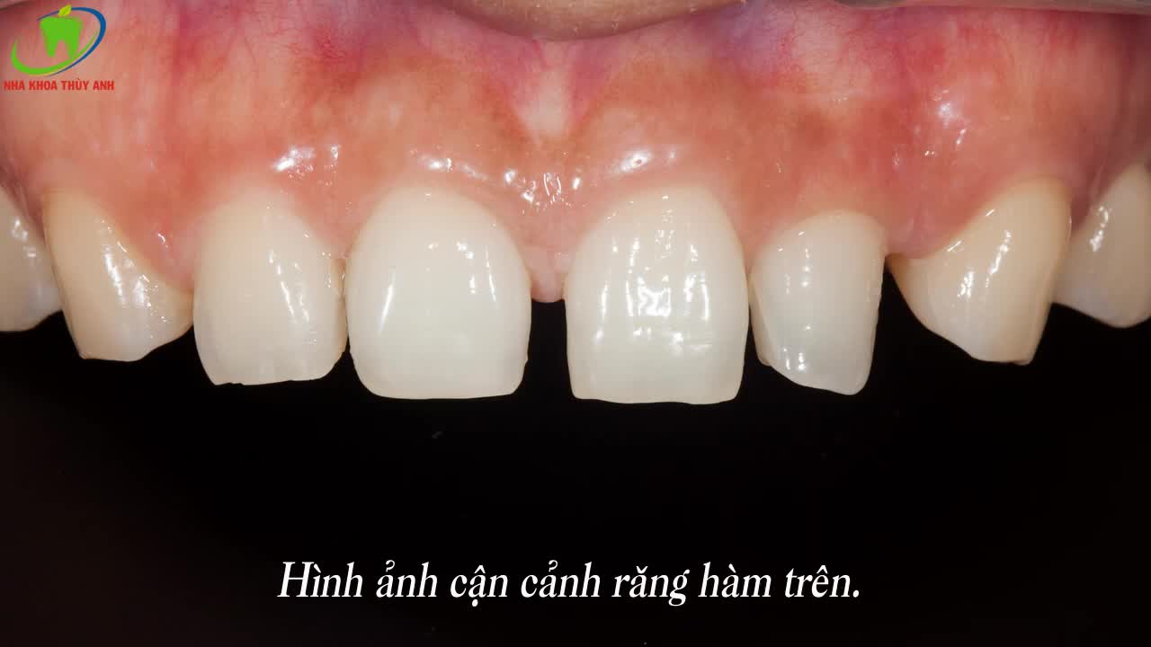 NHA KHOA THÙY ANH XÓA TAN KHE THƯA CHỈ SAU HAI BUỔI HẸN