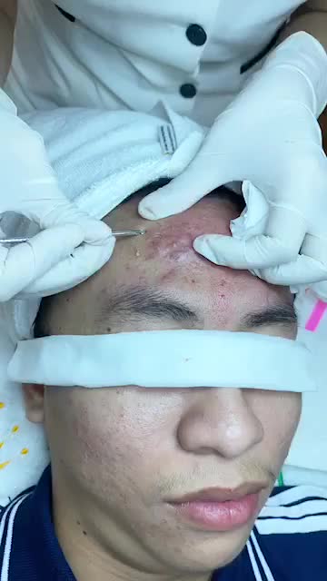 Cận cảnh ca nặn mụn kinh điển của khách hàng 17 tuổi.