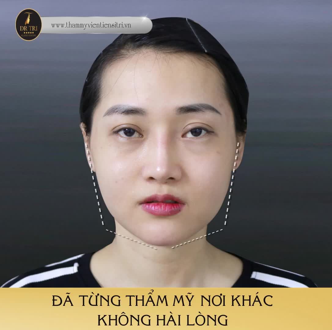 GỌT HÀM NÂNG MŨI ASHAPE - CẮT MÍ TRÊN, COMBO THẦN THÁNH LÀM NÊN NÉT ĐẸP HOÀN HẢO