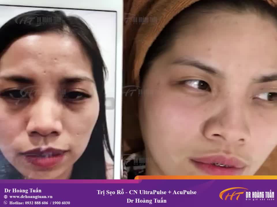 Lấp đầy sẹo rỗ với bộ đôi siêu công nghệ trị sẹo mạnh nhất - UltraPulse  AcuPulse