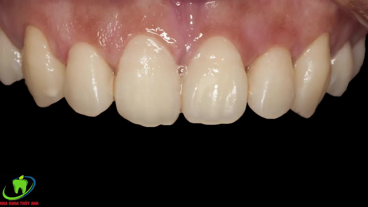 Chấm dứt hở lợi nụ cười của bạn sẽ như thế nào