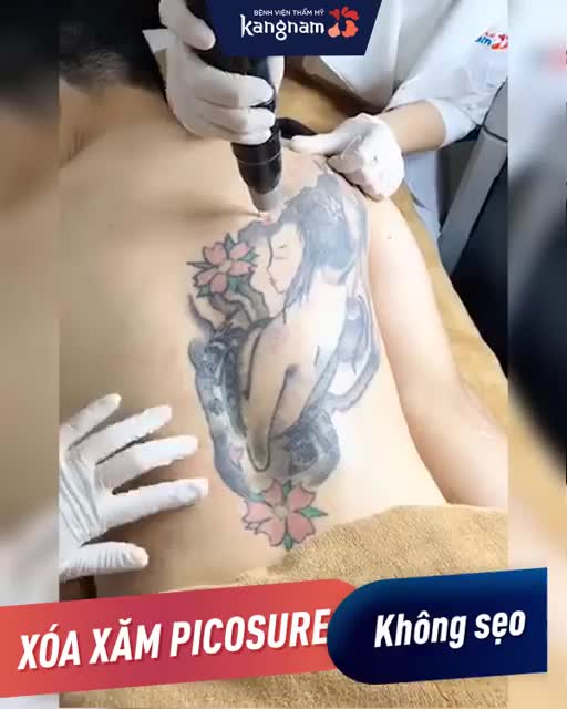 XÓA XĂM Laser Picosure - Xóa xăm "GẤP" + Không để lại sẹo