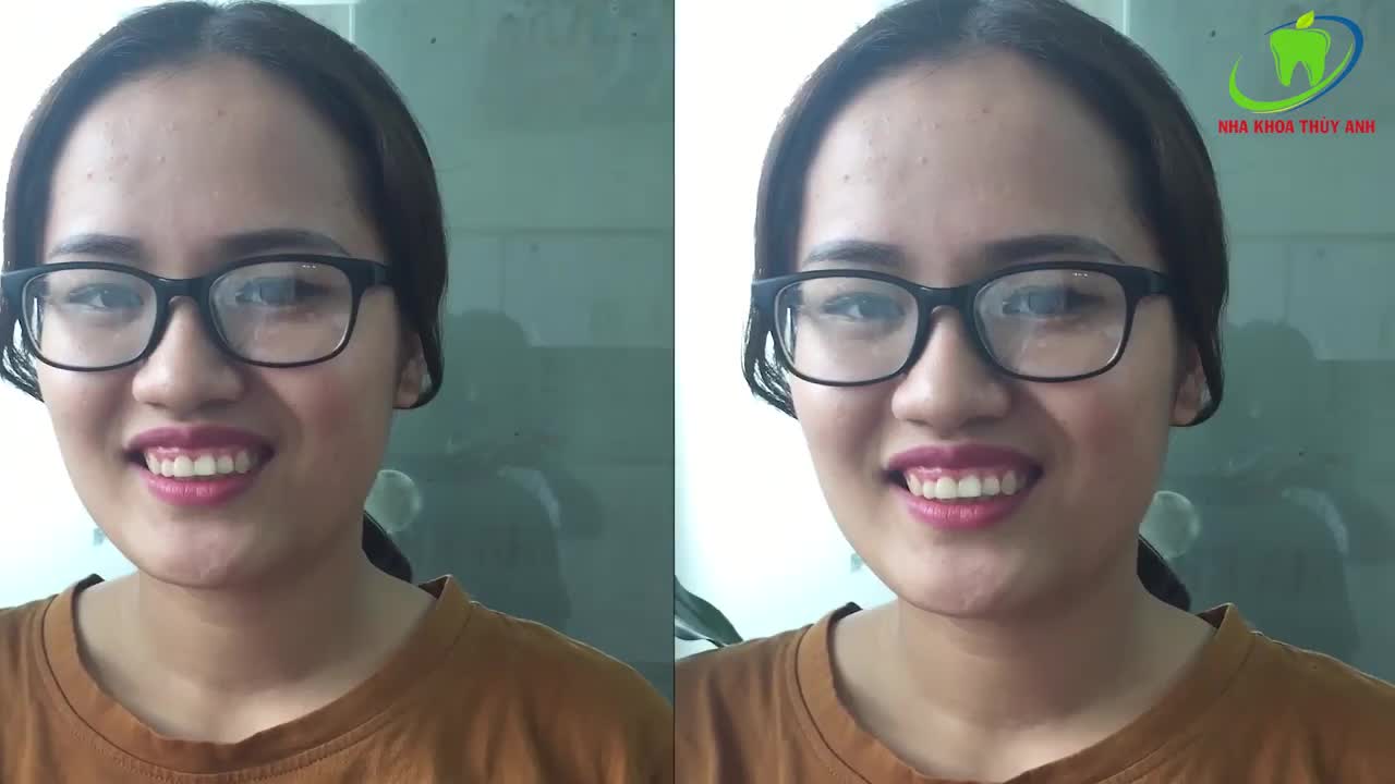 PHẪU THUẬT CƯỜI HỞ LỢI - TÌM RA NỤ CƯỜI HOÀN HẢO CỦA BẠN CÙNG NHA KHOA THÙY ANH