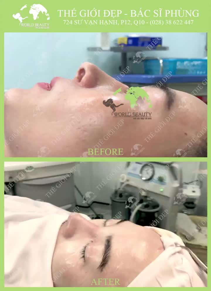 Dành cả thanh xuân để đi sửa mũi