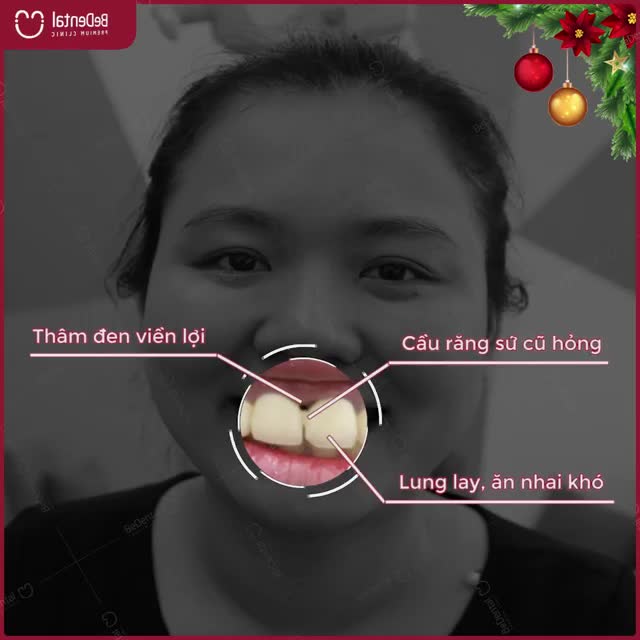 Khắc phục răng mất bằng CẦU RĂNG SỨ