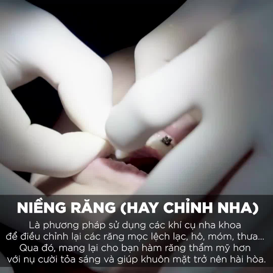NIỀNG RĂNG - Lột Xác Chỉ Sau 6 Tháng
