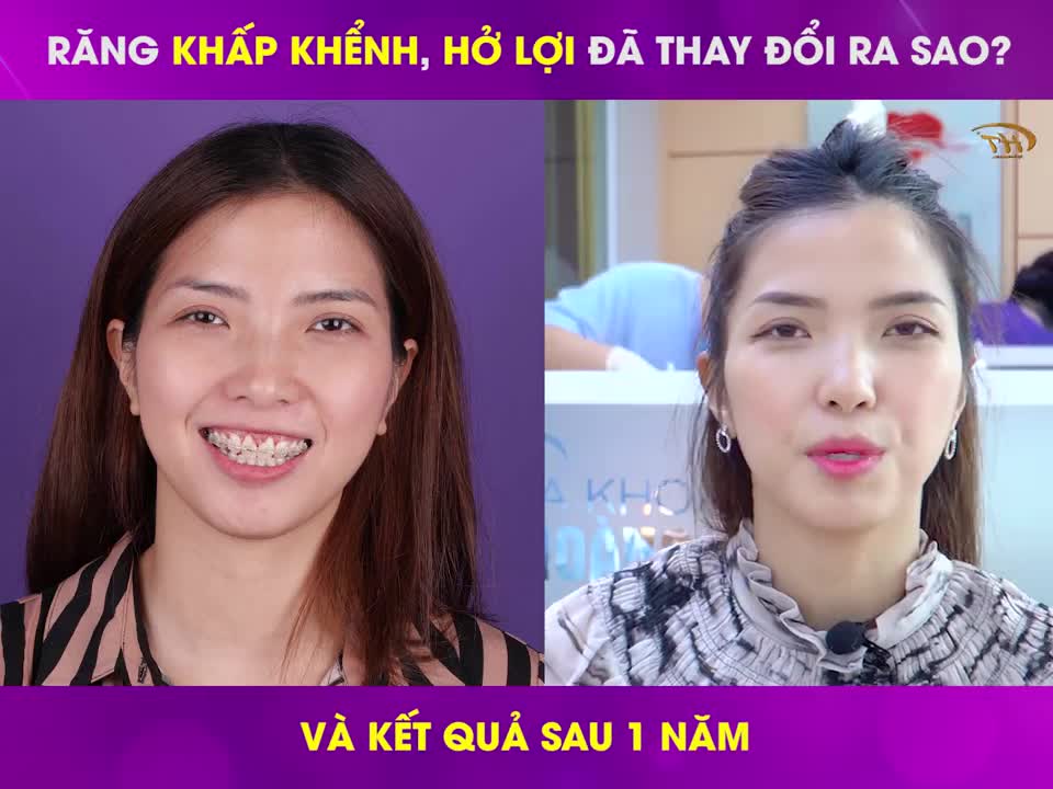 Răng khấp khểnh, cười hở lợi đã thay đổi ra sao sau khi trải nghiệm combo dịch vụ tại Nha khoa thẩm mỹ Hoàng Tuấn?