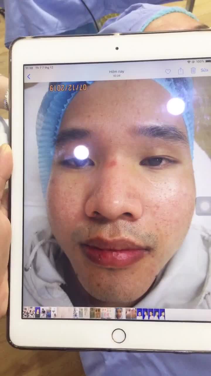 Cận cảnh điều trị sẹo lõm lâu năm bằng CN Bio Scar