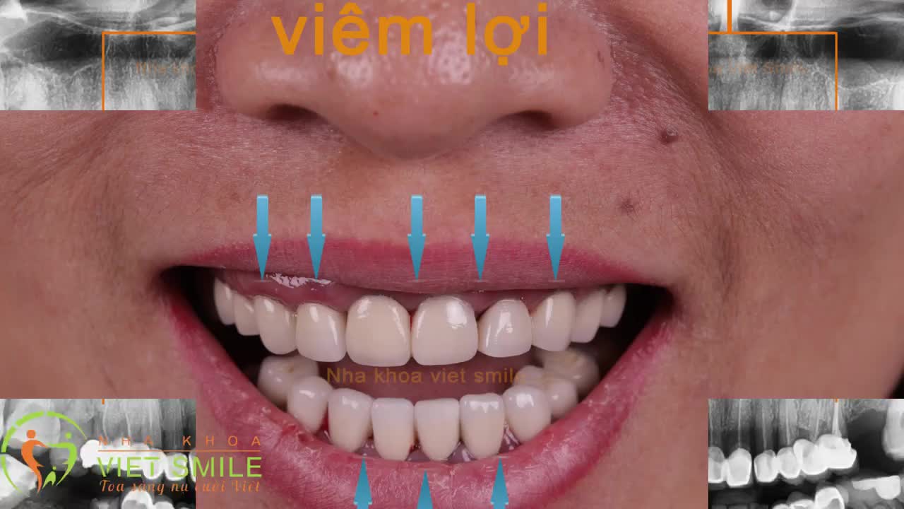 Răng nhiễm màu kháng sinh Tetracilin