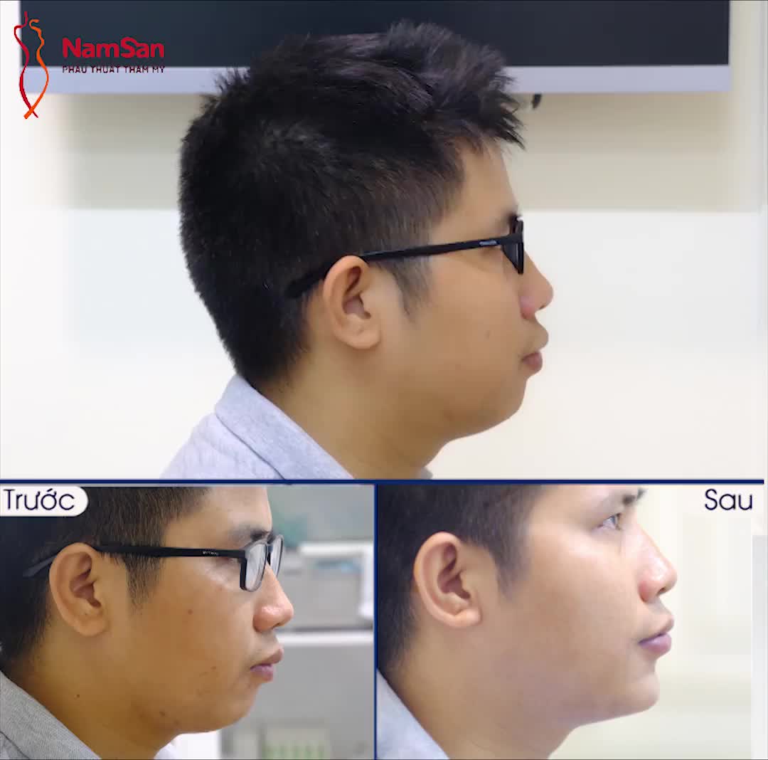 "Giải Cứu" Cằm lẹm ngắn cho Nam chỉ sau 45 phút Độn Cằm Cố Định Nội Sinh