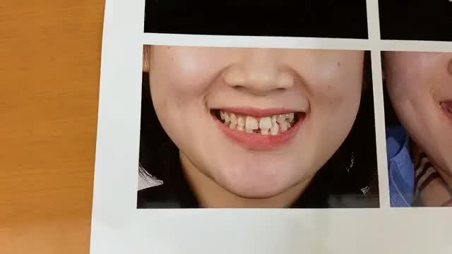 Gắn răng veneer cho chị Ngân tai Nha Khoa Thùy Anh.