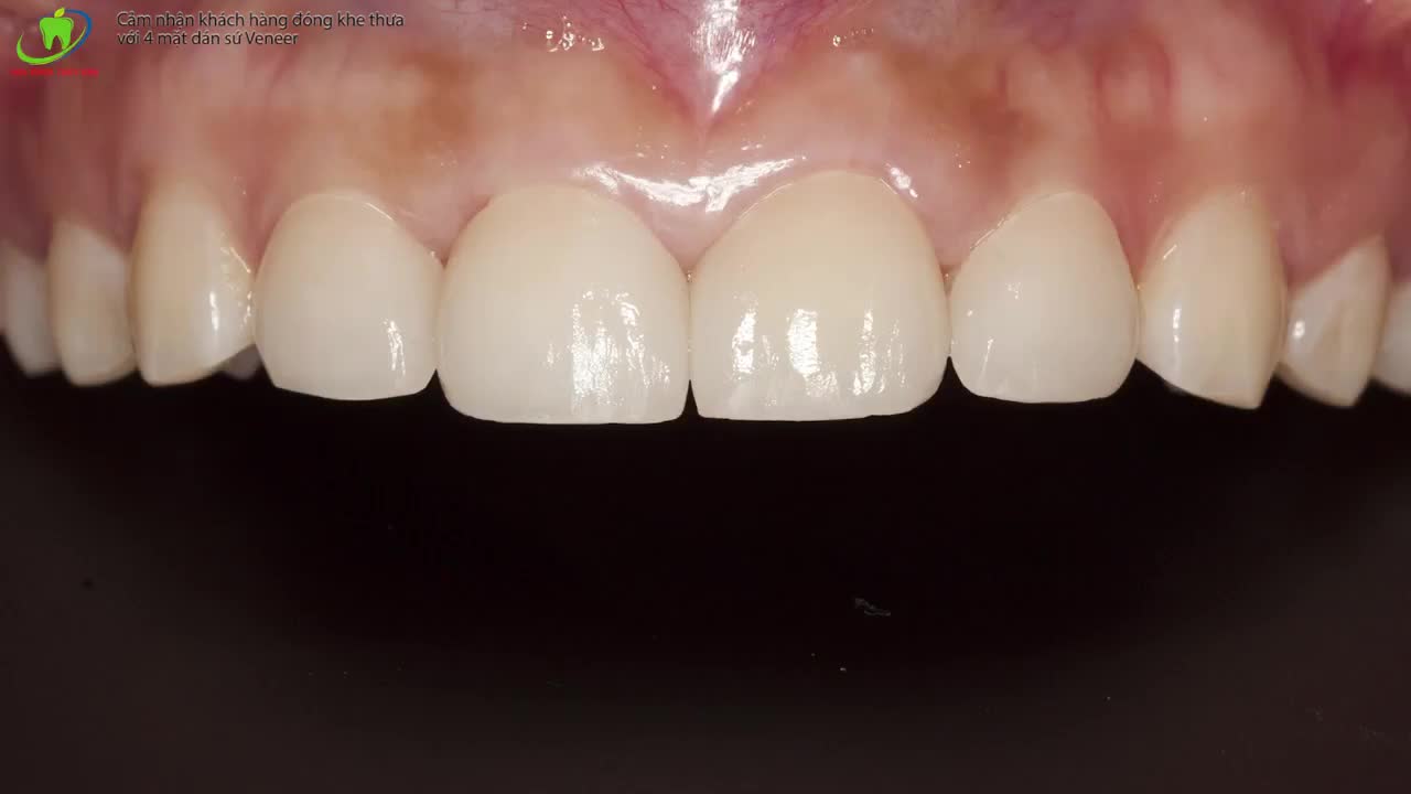 DÁN SỨ VENEER - CỨU CÁNH CHO HÀM RĂNG THƯA.