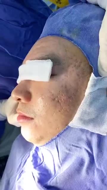 Hết sẹo lõm, rỗ tới 85% nhờ Cấy da siêu vi điểm