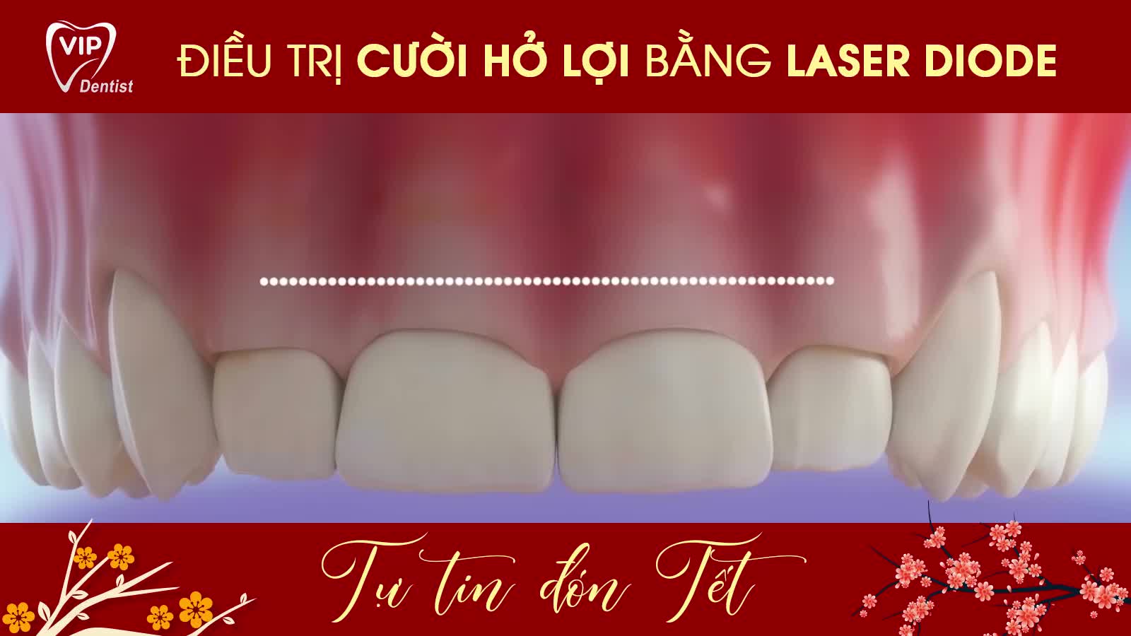 Tết này tha hồ cười thả ga, không còn ngại ngùng "cười che miệng" như trước khi đã có Vip Dentist đồng hành cùng nụ cười