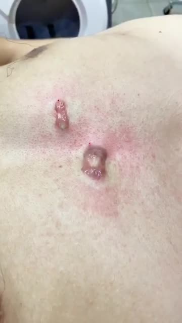 Điều trị sẹo lồi với công nghệ chiếu ánh sáng Ella