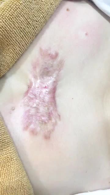 Điều trị sẹo lồi bằng công nghệ ánh sán Ella cải thiện ngay sau 1 lần điều trị