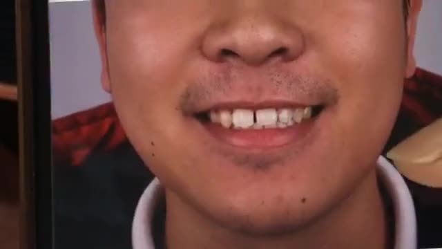 Dán sứ veneer đón tết cho khách hàng Thưa răng cửa