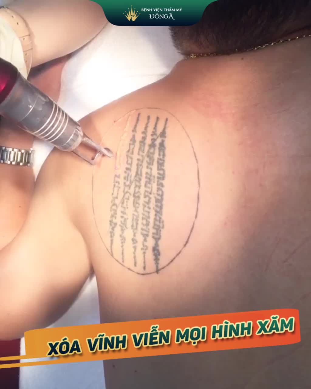 Ruby Lasser - XÓA XĂM siêu tốc