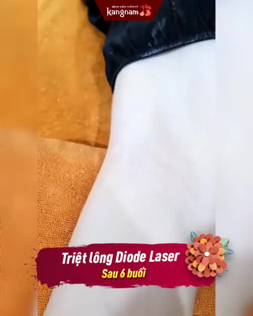 Triệt lông ưu đãi - 99K cho buổi đầu tiên