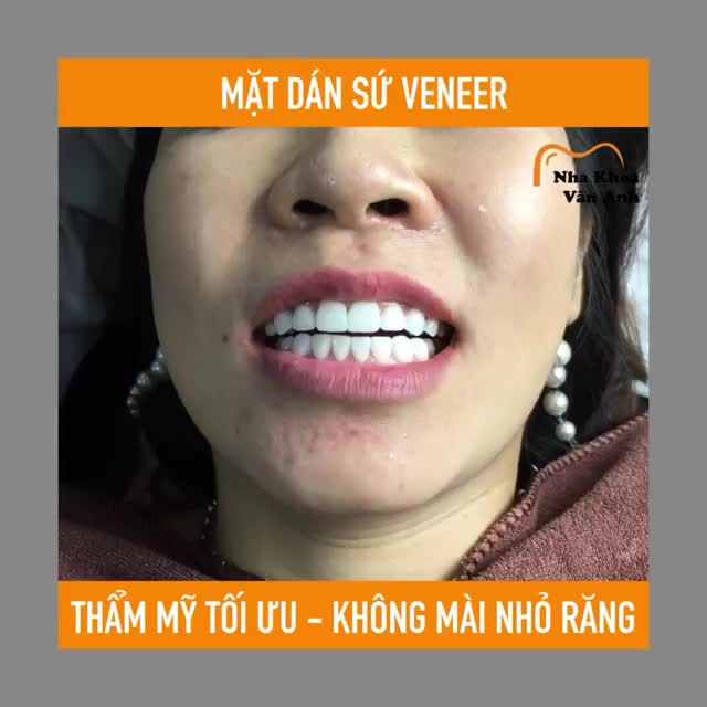 BẮC NINH MẶT DÁN SỨ VENEER - GIẢM NGAY 20%