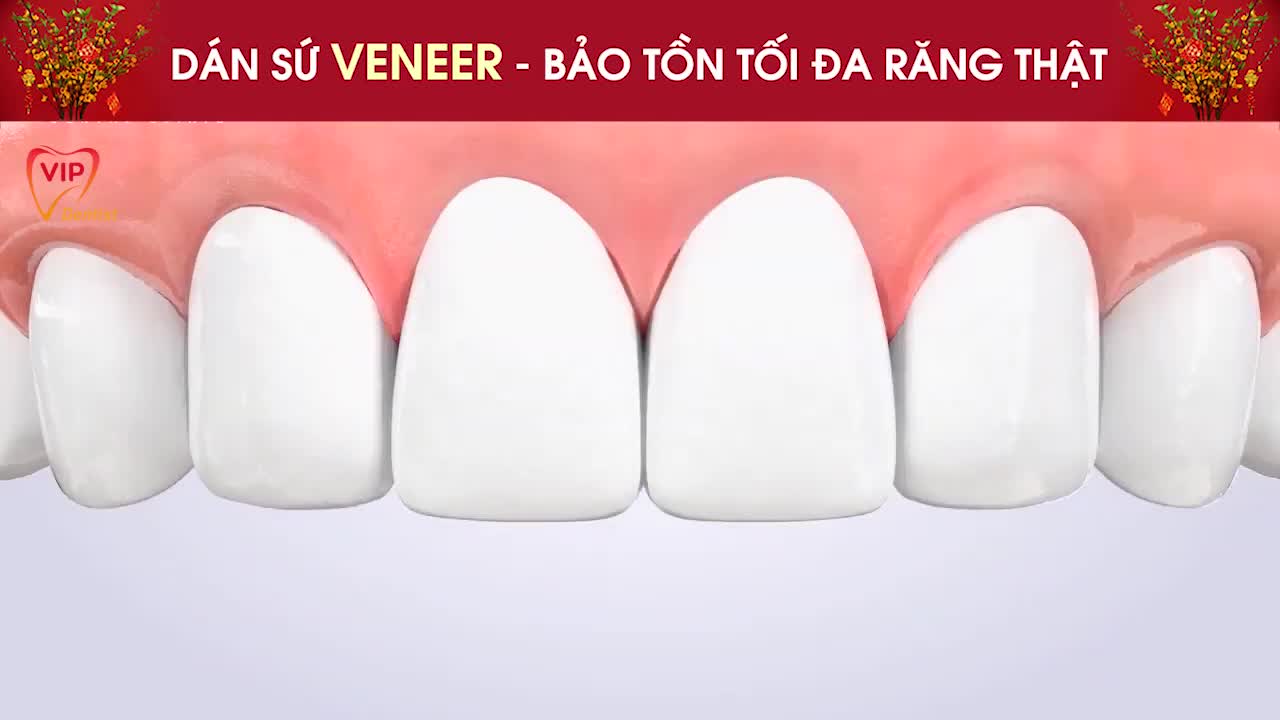 DÁN SỨ VENEER - BẢO TỒN TỐI ĐA RĂNG THẬT