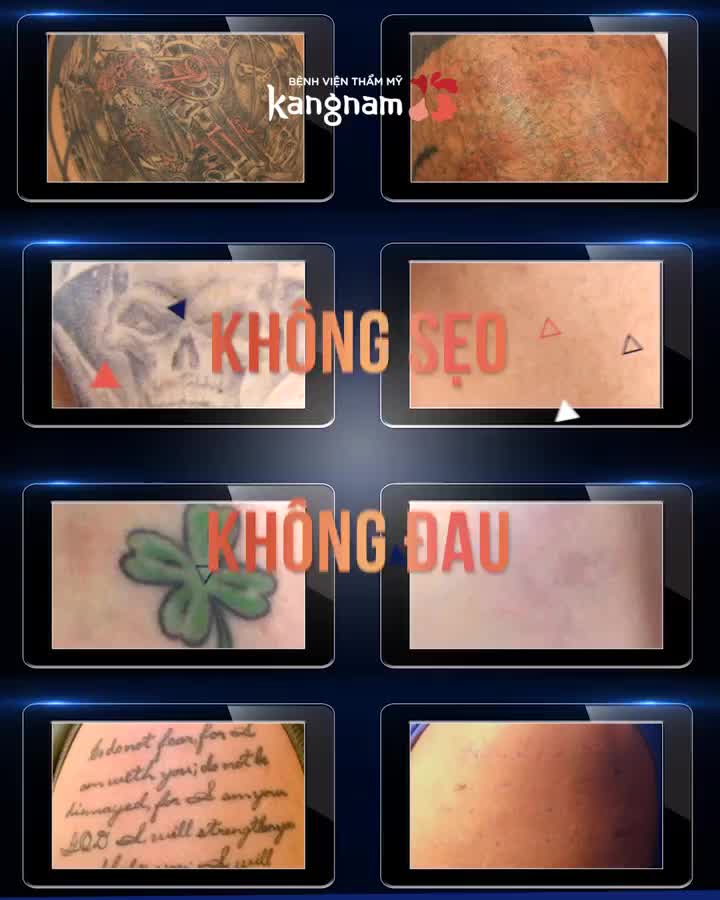 XÓA XĂM MIỄN PHÍ - Tại Tuần vàng Laser  20-27/2