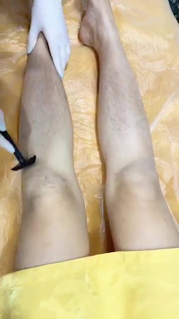 Triệt lông chân CN DIODE LASER của khách hàng tại Kangnam