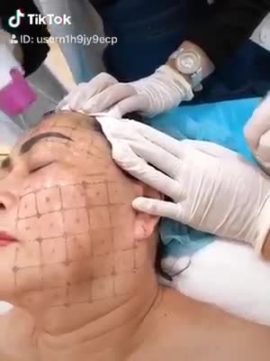 Cận cảnh quá trình trẻ hoá da bằng công nghệ Thermage FLX tại bệnh viện thẩm mỹ Đông Á