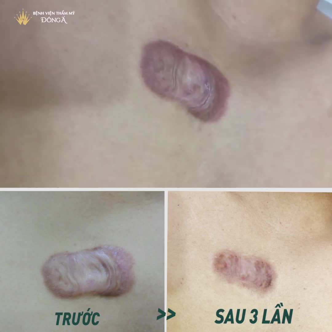 SẸO LỒI CỠ MẤY  XẸP NGAY CHỈ SAU 1 LIỆU TRÌNH
