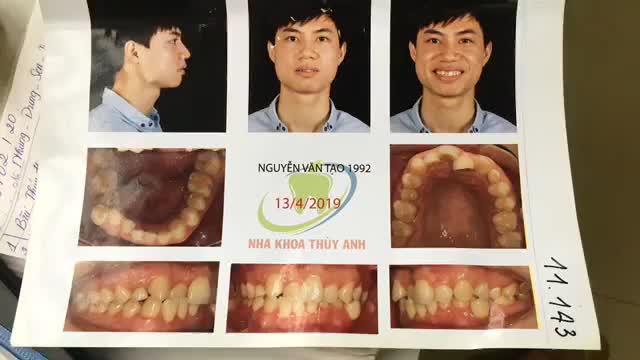 Gắn mắc cài chỉnh nha điều trị răng lệch lạc.