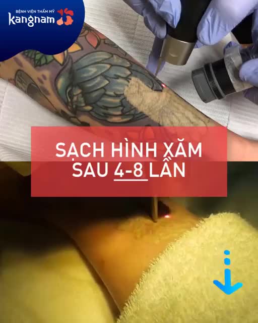 XÓA XĂM - Rút ngắn thời gian với Laser Picosure công nghệ Mỹ