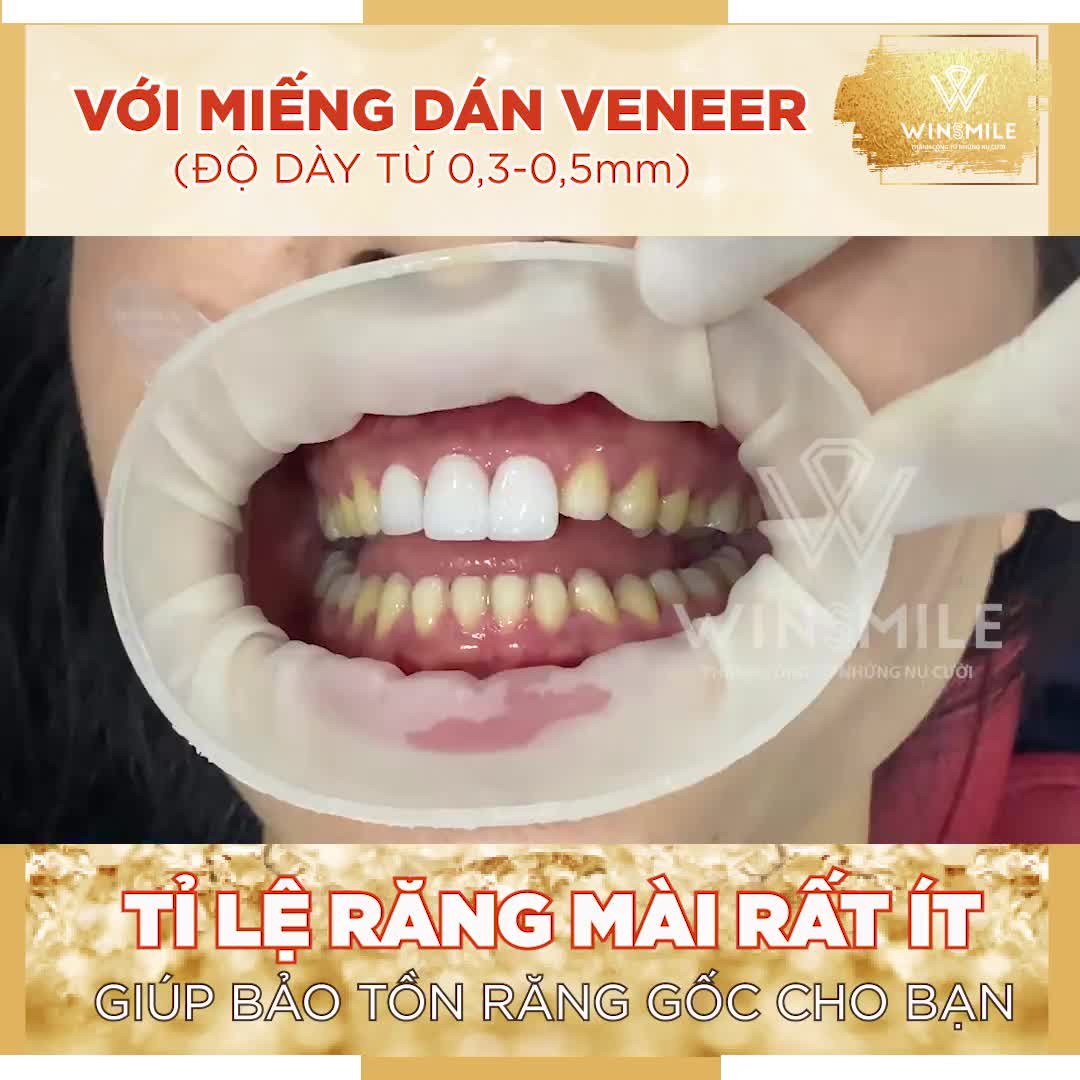 MẶT DÁN SỨ VENEER SIÊU MỎNG - BẢO TỒN RĂNG GỐC - GIỮ NGUYÊN RĂNG THẬT