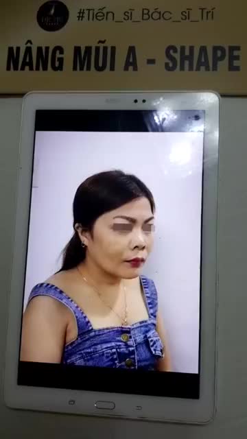 Chị khách trước đó sở hữu dáng mũi chưa hoàn hảo với