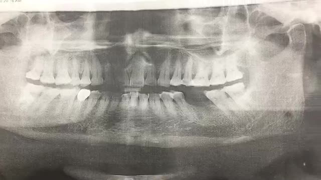 Cấy implant tại Nha Khoa Thuỳ Anh.