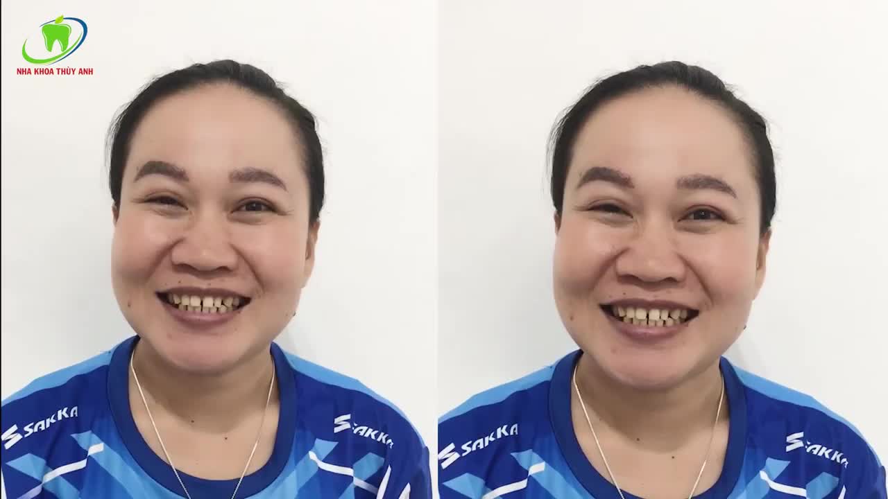 DÁN SỨ VENEER GIẢI CỨU TÌNH TRẠNG KHE THƯA, RĂNG DỊ DẠNG