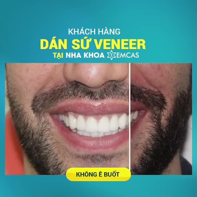LỢI ÍCH KHÔNG NGỜ KHI DÁN SỨ VENEER TẠI EMCAS
