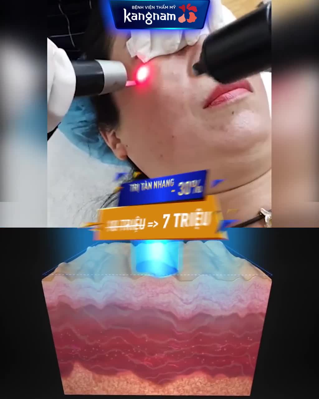 TRỊ NÁM  TÀN NHANG GIÁ TỐT chỉ có ở Kangnam
